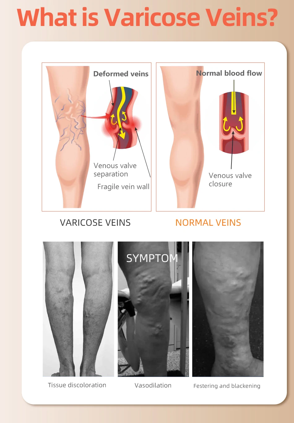 남녀공용 무릎 위 폐쇄 발가락 정맥류 양말, 의료용 허 - Compression Sock Medical 리뷰 및 가격